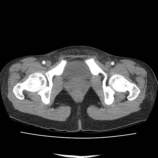 Acute myocarditis (Radiopaedia 55988-62613 Axial C+ portal venous phase 80).jpg