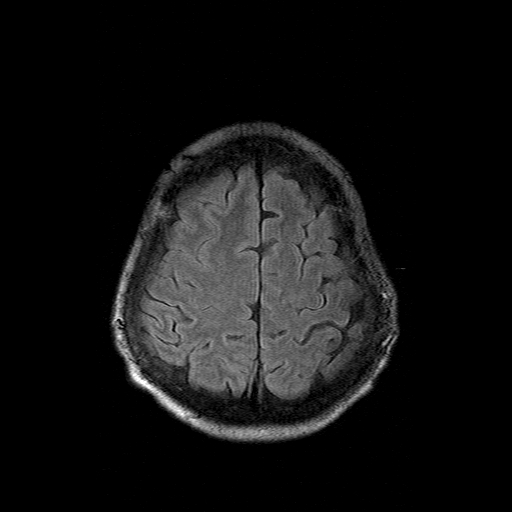 File:Acute necrotizing toxoplasma encephalitis (Radiopaedia 10683-11149 Axial FLAIR 3).jpg