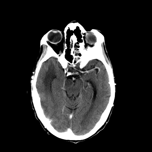 File:Acute necrotizing toxoplasma encephalitis (Radiopaedia 10683-11150 C+ arterial phase 20).jpg