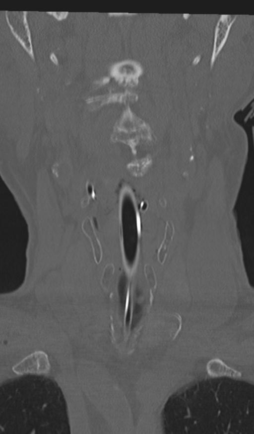 Acute on chronic subdural hematoma and thoracic vertebral injury in a multitrauma patient (Radiopaedia 31698-32619 Coronal bone window 8).jpg