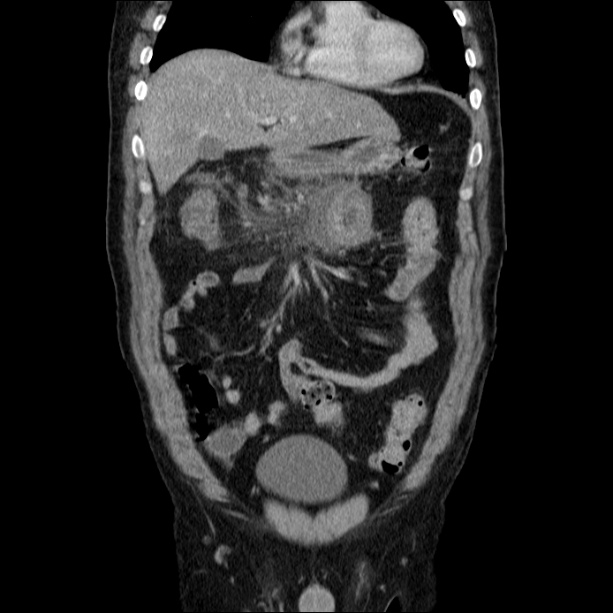 Acute pancreatitis (Radiopaedia 26663-26813 Coronal C+ portal venous phase 21).jpg