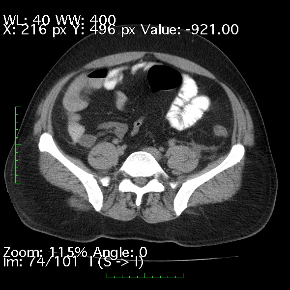 Acute pancreatitis (Radiopaedia 34043-35276 Axial non-contrast 74).jpg