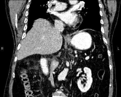 Acute pancreatitis (Radiopaedia 85146-100701 Coronal C+ portal venous phase 42).jpg