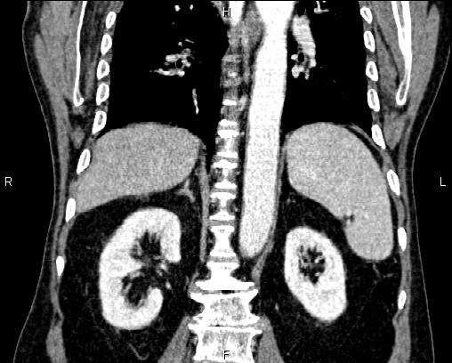 Acute pancreatitis (Radiopaedia 85146-100701 Coronal C+ portal venous phase 52).jpg