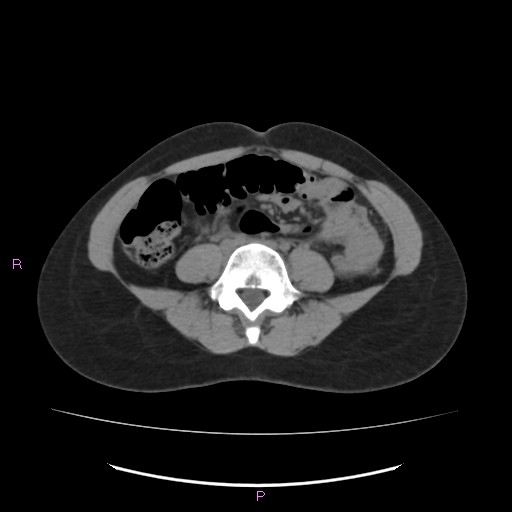 Acute pancreatitis secondary to stone at minor papilla and pancreatic divisum (Radiopaedia 76570-88333 Axial non-contrast 45).jpg
