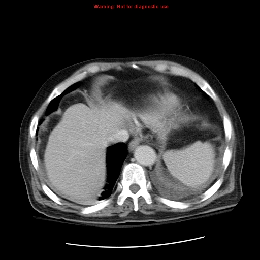File:Acute pancreatitis with incidental pancreatic lipoma (Radiopaedia 10190-10730 Axial C+ portal venous phase 7).jpg