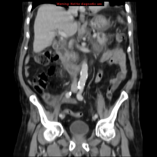 Acute pancreatitis with incidental pancreatic lipoma (Radiopaedia 10190-10730 Coronal C+ portal venous phase 35).jpg