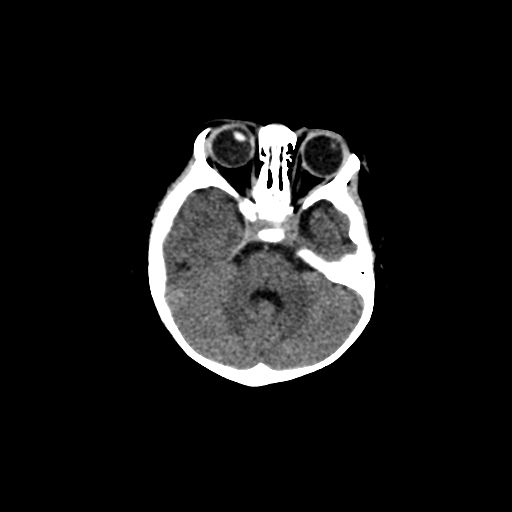Acute phase of hemiconvulsion-hemiplegia epilepsy syndrome (Radiopaedia 29309-29744 Axial non-contrast 39).jpg