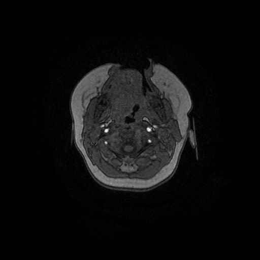 Acute phase of hemiconvulsion-hemiplegia epilepsy syndrome (Radiopaedia 29309-29745 Axial TOF angiography 170).jpg