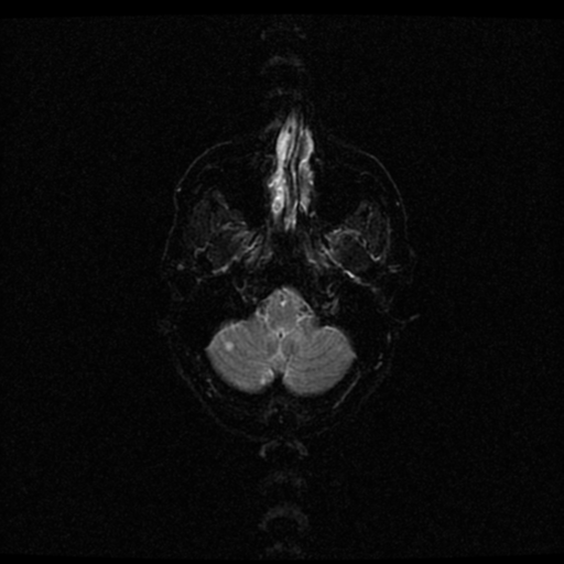 File:Acute pontine infarct from vertebral artery dissection (Radiopaedia 34111-35370 Axial Echo planar 2).png