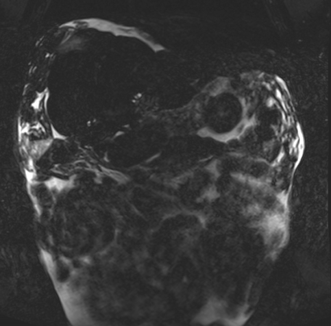 Acute portal vein thrombosis (Radiopaedia 73198-83925 Coronal Heavily T2 thin cuts 3).jpg