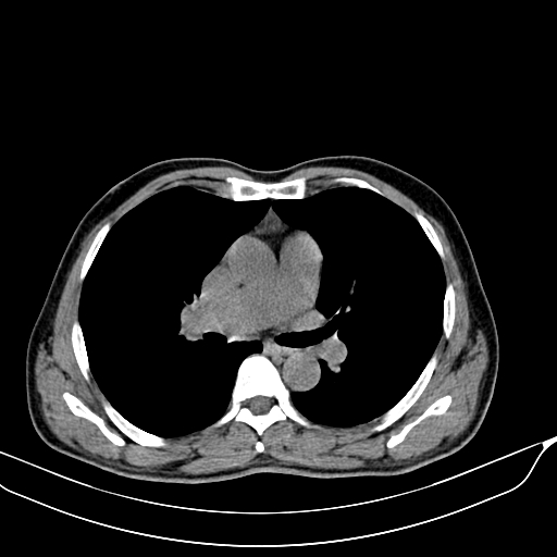File:Acute pulmonary embolism (Radiopaedia 69510-79390 Axial non-contrast 8).jpg