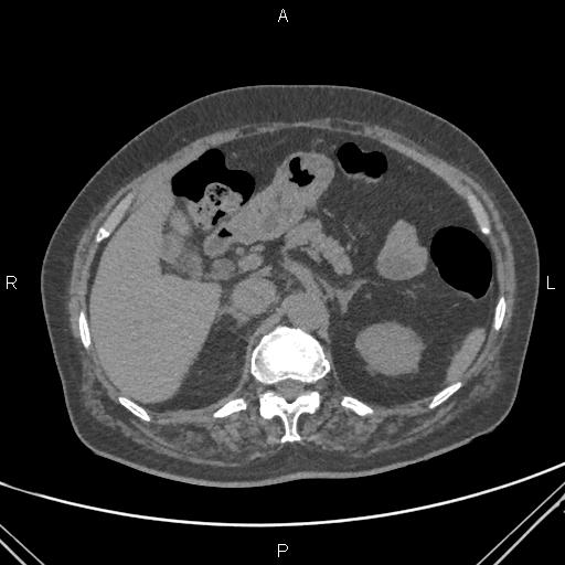 File:Acute renal artery occlusion (Radiopaedia 86586-102682 Axial non-contrast 21).jpg