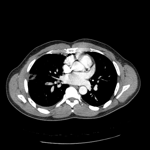 Acute segmental pulmonary emboli and pulmonary infarction (Radiopaedia 62264-70444 Axial C+ CTPA 62).jpg