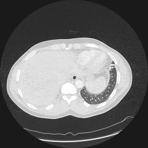 File:Acute segmental pulmonary emboli and pulmonary infarction (Radiopaedia 62264-70444 Axial lung window 165).jpg