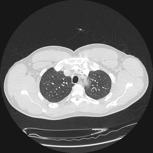 Acute segmental pulmonary emboli and pulmonary infarction (Radiopaedia 62264-70444 Axial lung window 37).jpg