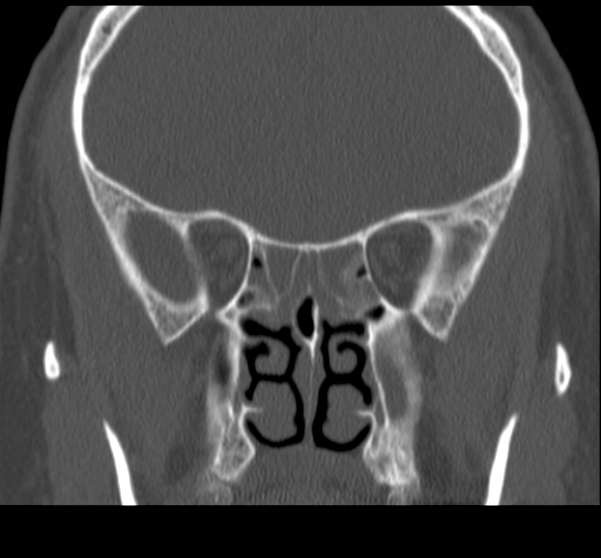 Acute sinusitis (Radiopaedia 23161-23215 Coronal bone window 42).jpg