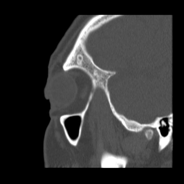 Acute sinusitis (Radiopaedia 23161-23215 Sagittal bone window 12).jpg