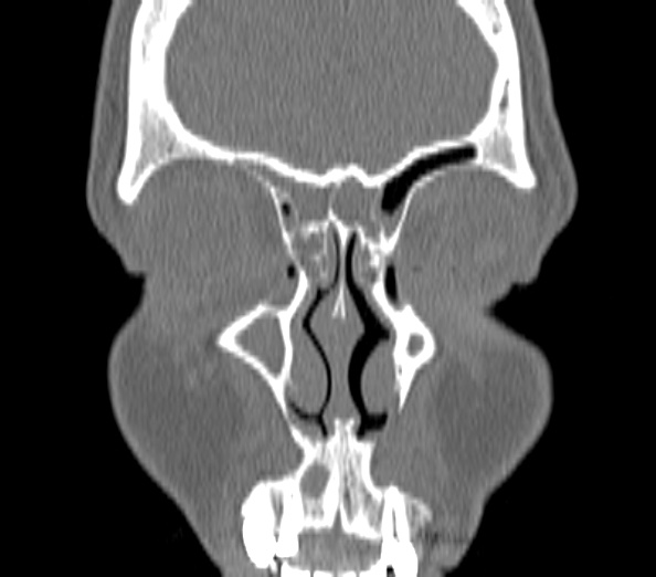 File:Acute sinusitis (Radiopaedia 40564-43158 Coronal bone window 6).jpg