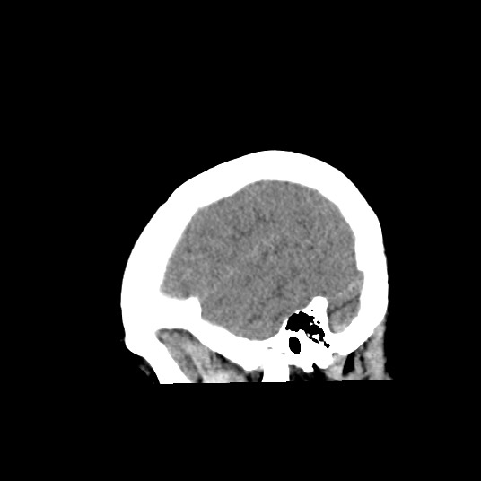 Acute subarachnoid hemorrhage and accessory anterior cerebral artery (Radiopaedia 69231-79008 Sagittal non-contrast 49).jpg
