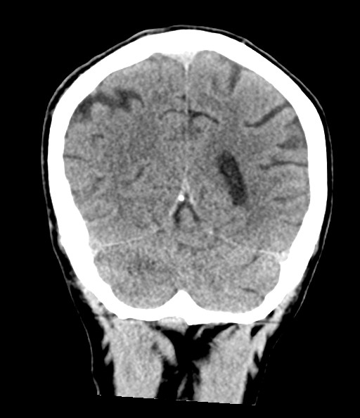 Acute superior cerebellar artery territory infarct (Radiopaedia 84104-99359 Coronal non-contrast 67).jpg