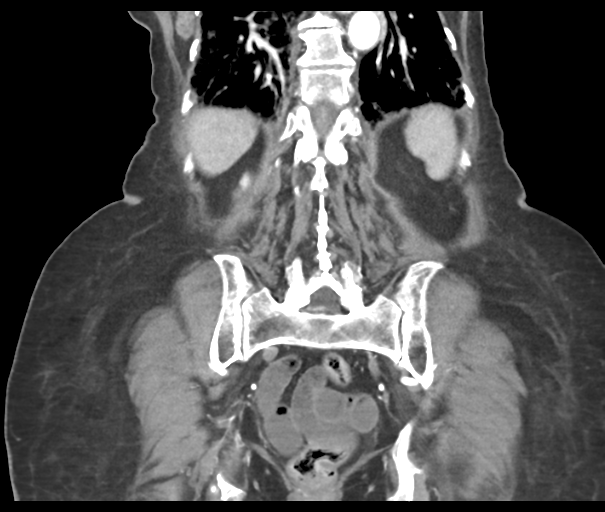 Acute superior mesenteric artery occlusion (Radiopaedia 43926-47418 Coronal C+ portal venous phase 38).png