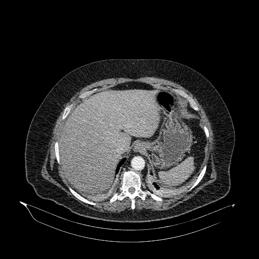 File:Acute superior mesenteric artery occlusion (Radiopaedia 51288-56960 Axial C+ arterial phase 10).jpg