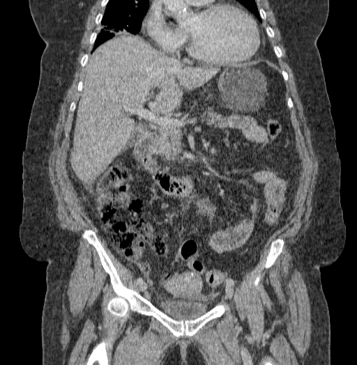 Acute superior mesenteric artery occlusion (Radiopaedia 51288-56960 Coronal C+ portal venous phase 36).jpg
