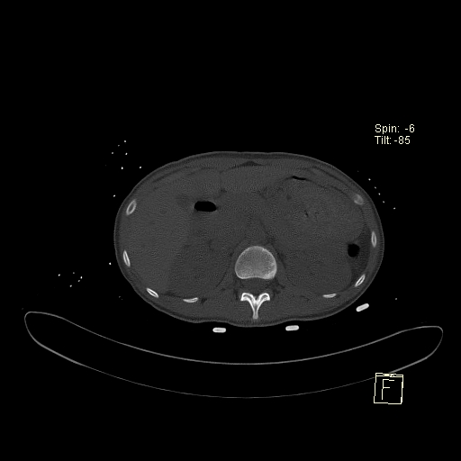 File:Acute vertebral compression fracture (Radiopaedia 63832-72559 Axial bone window 5).jpg