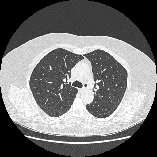 Adenocarcinoma in situ of lung (Radiopaedia 38685-40829 B 83).png