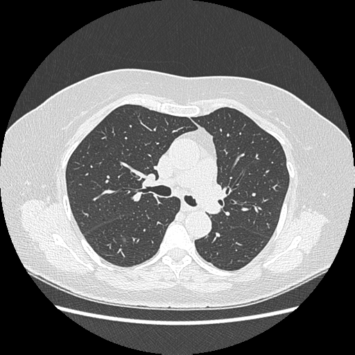 Adenocarcinoma in situ of lung (Radiopaedia 38685-40829 B 94).png
