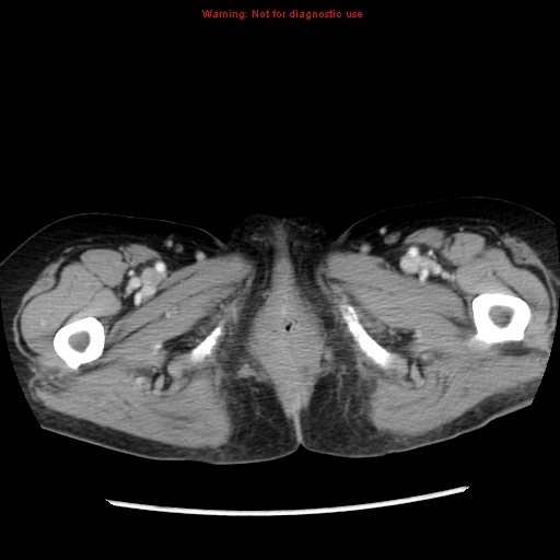 Adenocarcinoma of the colon (Radiopaedia 8191-9039 Axial liver window 82).jpg