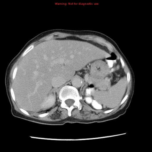 File:Adenocarcinoma of the colon (Radiopaedia 8191-9039 Axial renal excretory phase 4).jpg