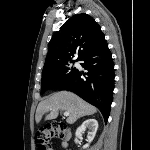 File:Adenocarcinoma of the lung (Radiopaedia 59871-67325 Sagittal C+ arterial phase 34).jpg