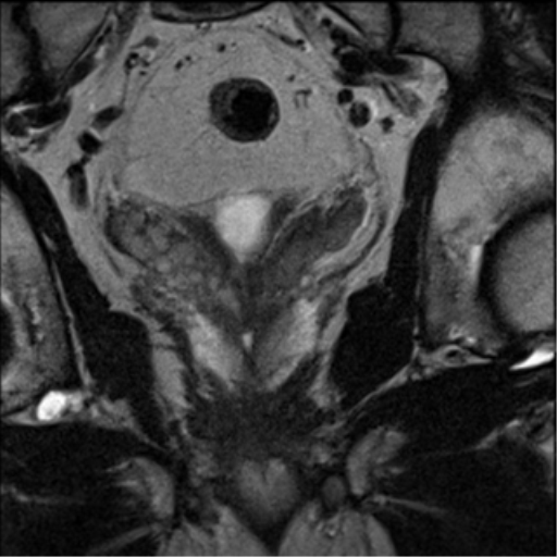 File:Adenocarcioma of rectum- T1 lesion (Radiopaedia 36921-38546 Coronal T2 15).png