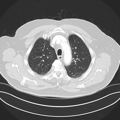 Adenocarcioma of rectum- T1 lesion (Radiopaedia 36921-38547 Axial lung window 17).png