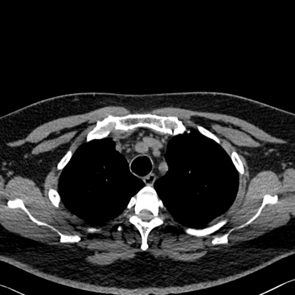 File:Adenoid cystic carcinoma of the trachea (Radiopaedia 49042-54137 Axial non-contrast 69).jpg