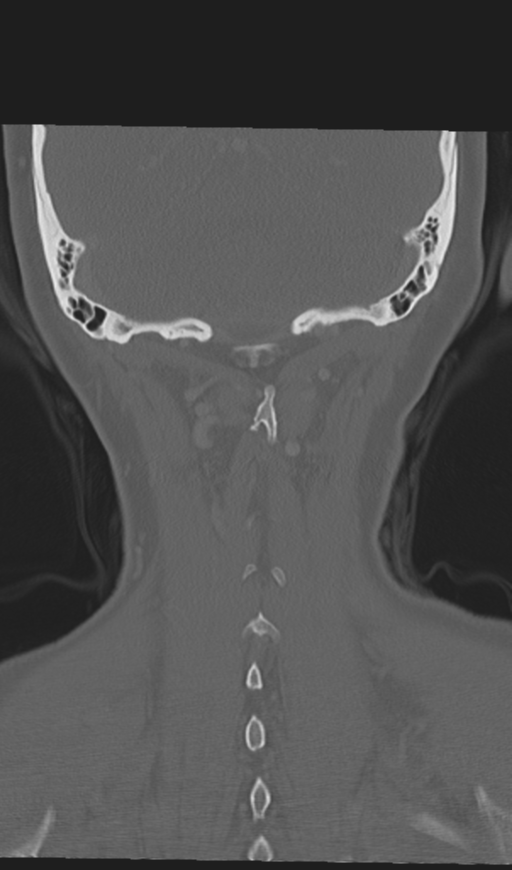 Adenoid cystic tumor of palate (Radiopaedia 46980-51518 Coronal bone window 51).png