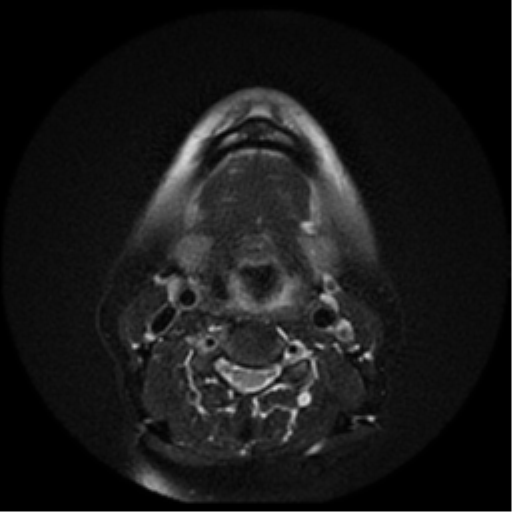 File:Adenoid cystic tumor of palate (Radiopaedia 46980-51519 Axial T2 9).png