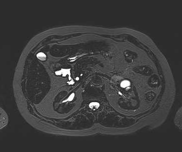 File:Adenomyomatosis of the gallbladder (Radiopaedia 50246-55587 Axial 38).png