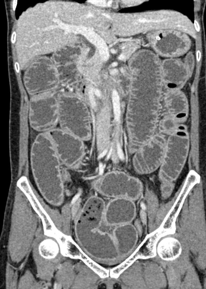 Adhesional small bowel obstruction (Radiopaedia 48397-53305 Coronal C+ portal venous phase 162).jpg