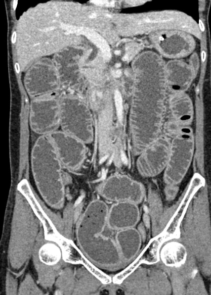 Adhesional small bowel obstruction (Radiopaedia 48397-53305 Coronal C+ portal venous phase 164).jpg