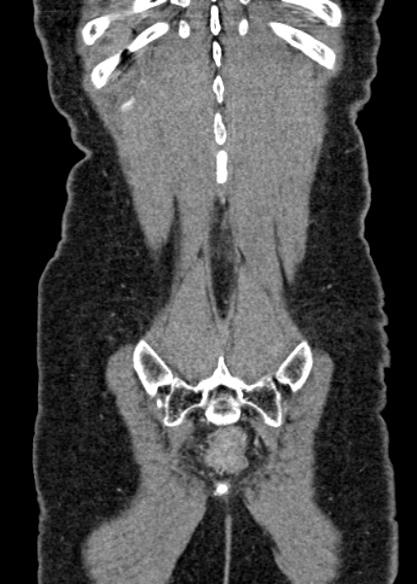 Adhesional small bowel obstruction (Radiopaedia 48397-53305 Coronal C+ portal venous phase 317).jpg