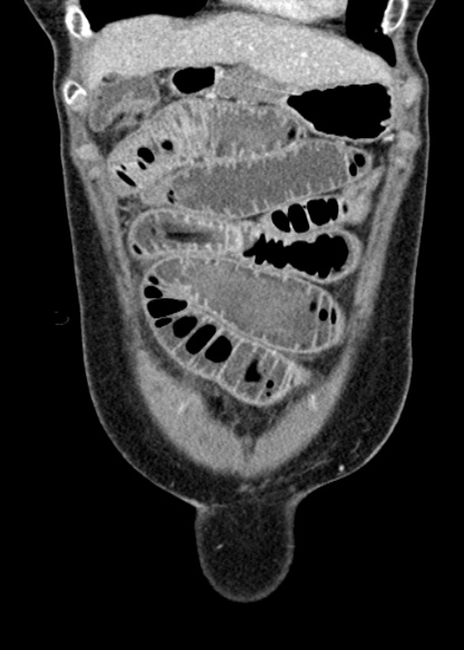 Adhesional small bowel obstruction (Radiopaedia 48397-53305 Coronal C+ portal venous phase 67).jpg