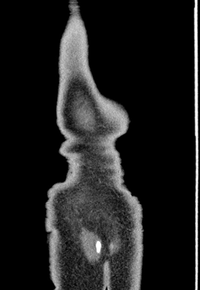 Adhesional small bowel obstruction (Radiopaedia 52107-57980 Coronal C+ portal venous phase 81).jpg