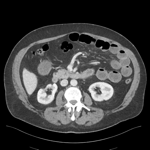Adhesions within abdominal wall hernia (Radiopaedia 58283-65394 Axial C+ portal venous phase 38).png