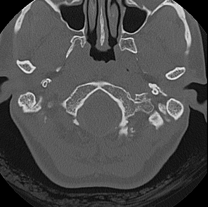 File:Adhesive chronic otitis media (Radiopaedia 14270-14148 Axial bone window 25).jpg
