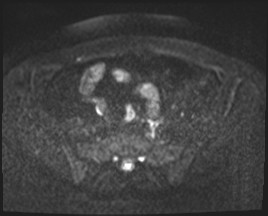 Adnexal multilocular cyst (O-RADS US 3- O-RADS MRI 3) (Radiopaedia 87426-103754 Axial DWI 34).jpg