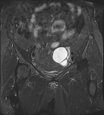 File:Adnexal multilocular cyst (O-RADS US 3- O-RADS MRI 3) (Radiopaedia 87426-103754 Coronal T2 fat sat 12).jpg