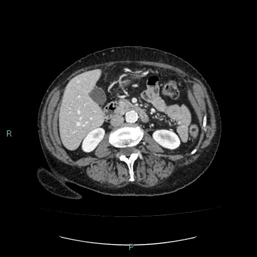 File:Adrenal collision tumor (ACT) (Radiopaedia 48462-53379 Axial C+ portal venous phase 28).jpg